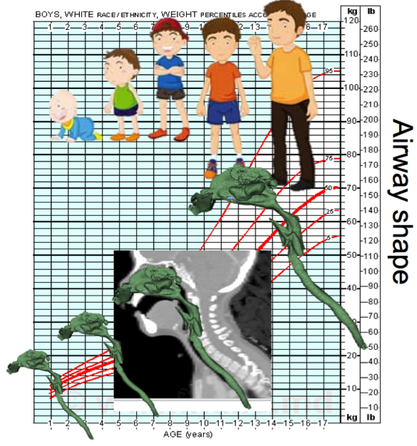 Idea behind the Pediatric Airway Project: building a growth chart for the airway. Creating methods for spatial alignment of airways to capture normal airway growth in children, which allows for the assessment of abnormal airways.